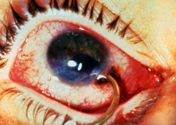 Eye protection – Hook, line & sinker